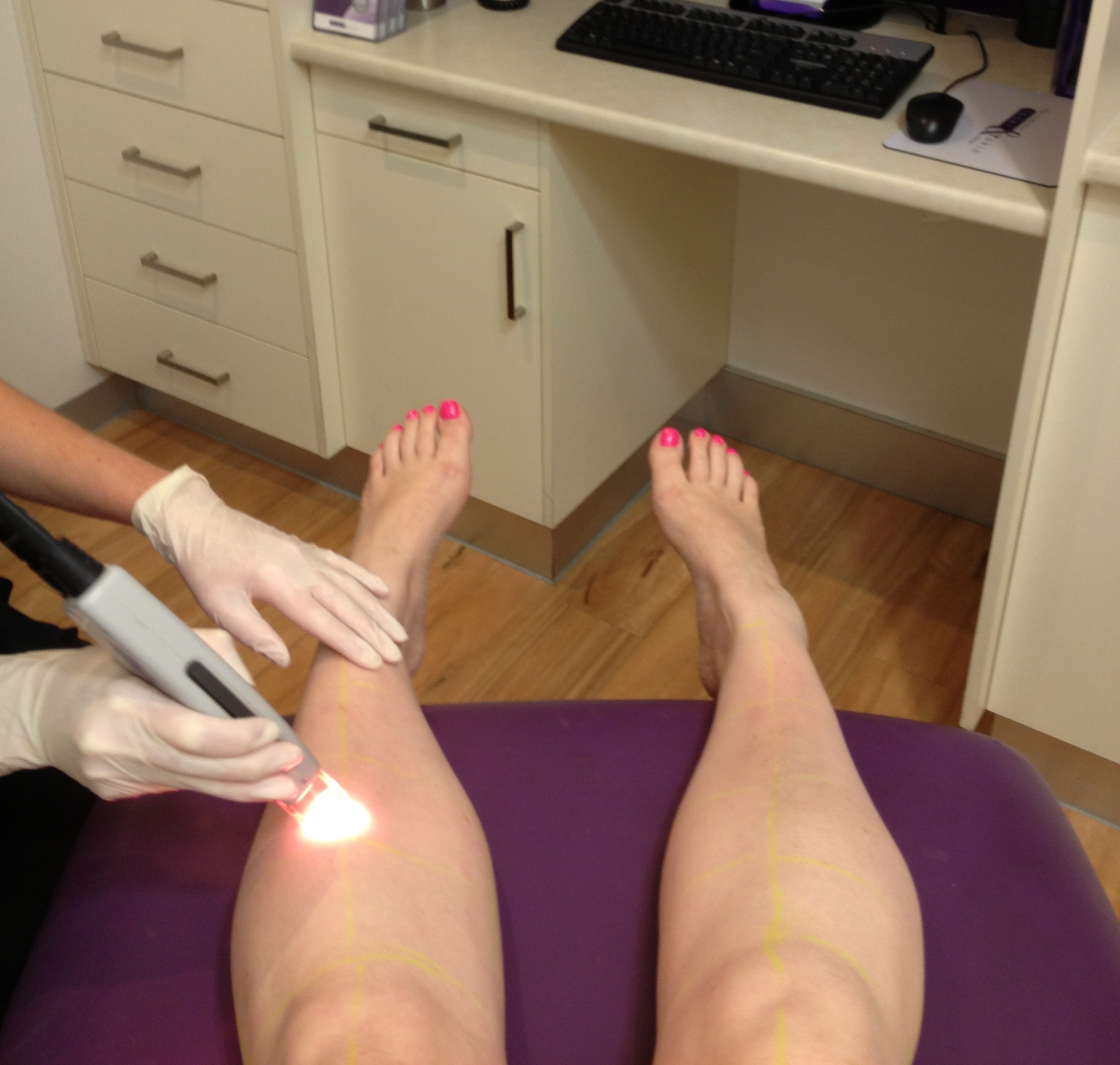 Laser Hair Removal - Road Tested - Part 1 - Melbourne Mamma - Fashion |  Food | Family | Fun | Shopping